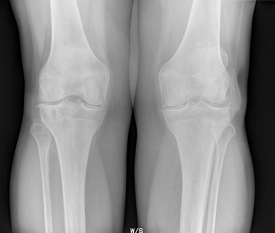 膝关节软骨钙质沉着的数字x光片
