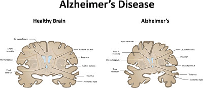 大脑和运动系统的阿尔茨海默病