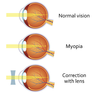 近视眼和近视眼用减透镜矫正。