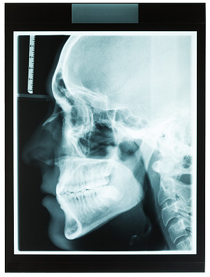 牙科医生的颌部x线照片