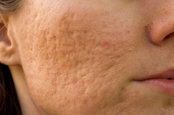 pores