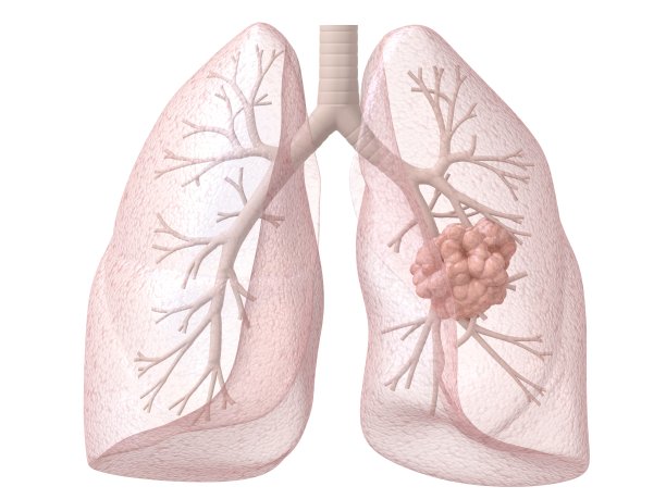 肺部肿瘤
