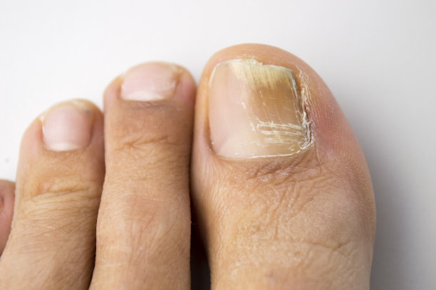 nail