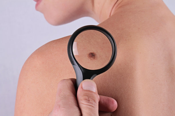 mole