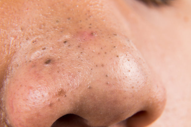 nose