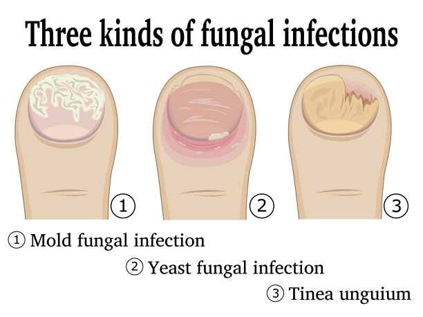 fungus