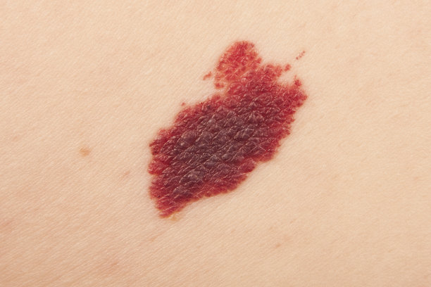 mole