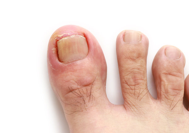 nail