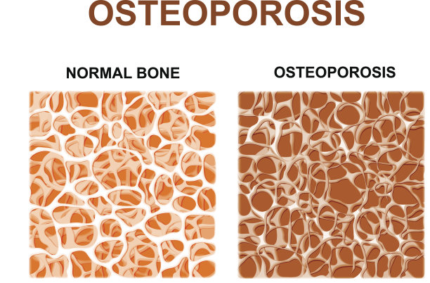 骨质疏松症