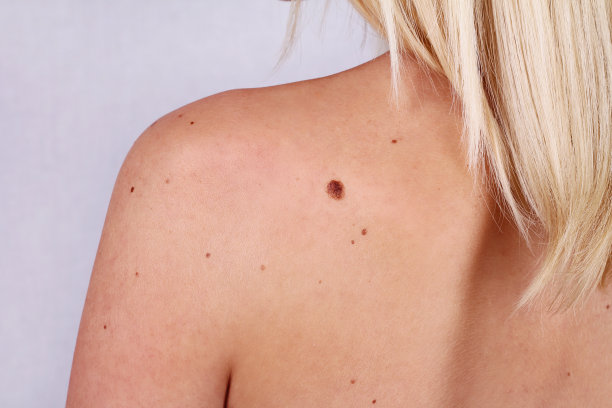 mole