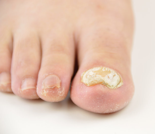 nail