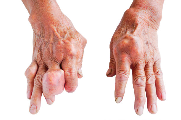 arthritis