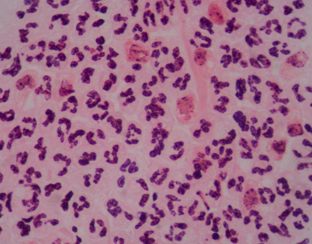 inflammation