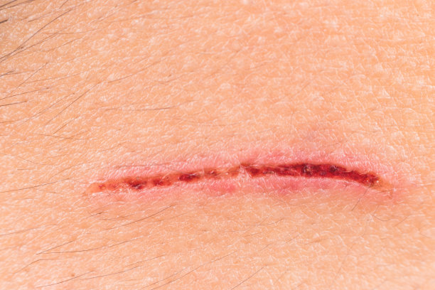 cuts