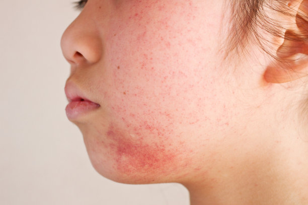 inflammation