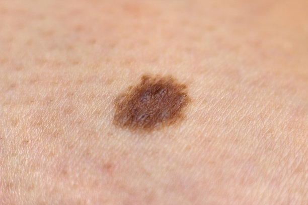 mole