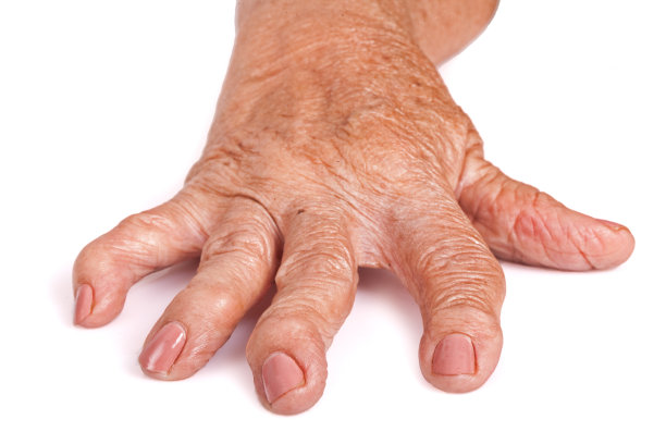 arthritis