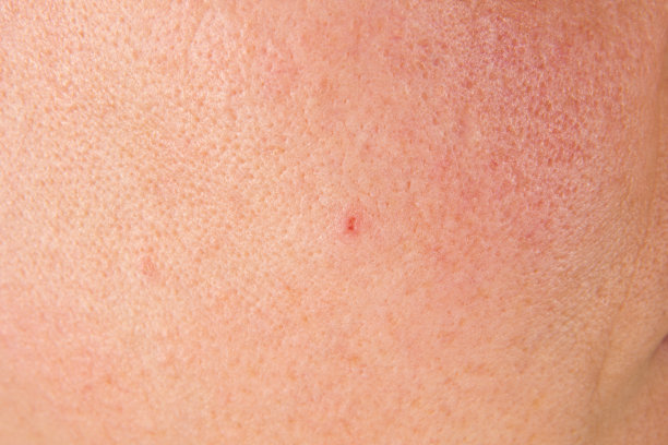 pores