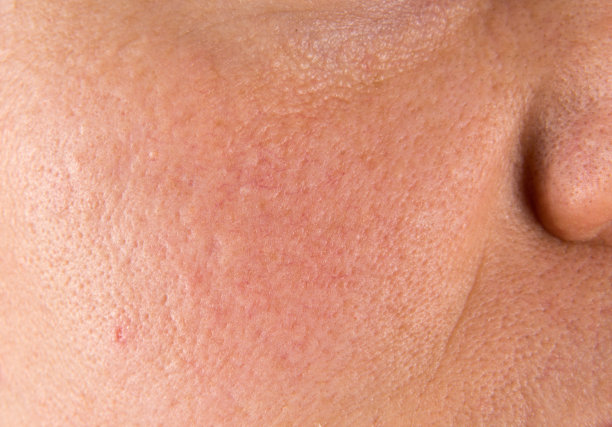 pores