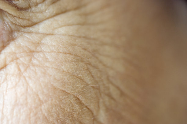 wrinkles