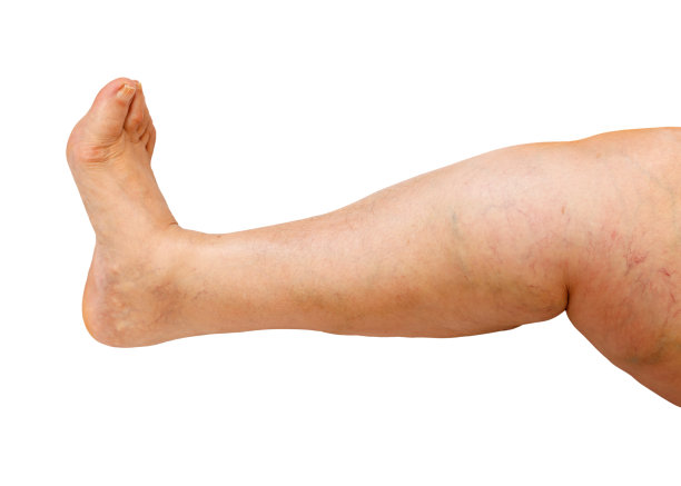limbs