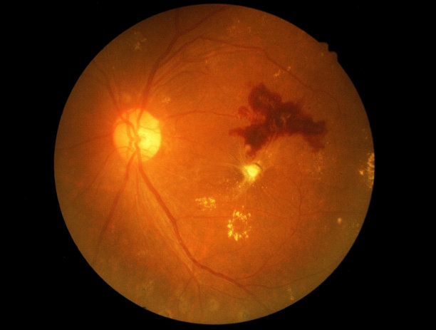 retina