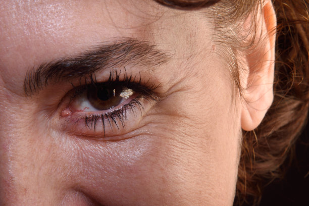 wrinkles