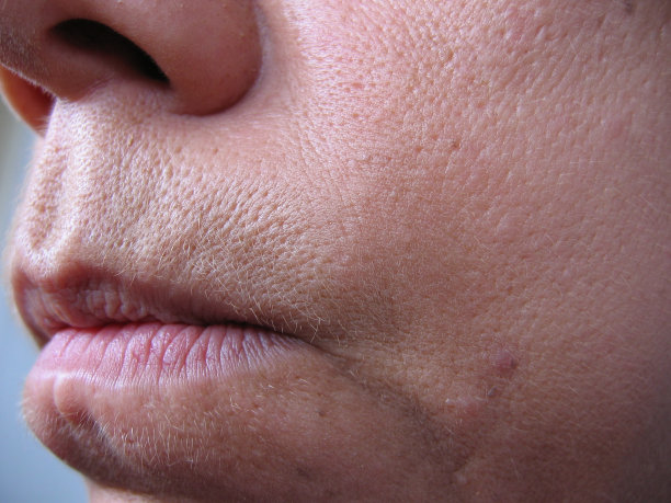 pores