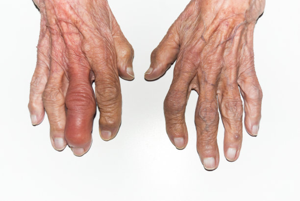 arthritis