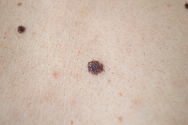 mole