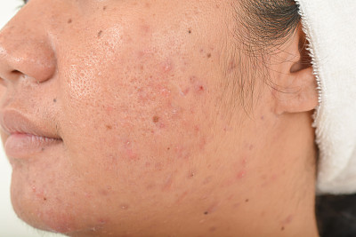 pores