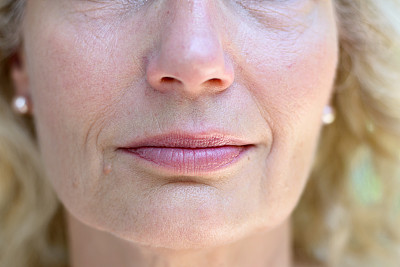 wrinkles