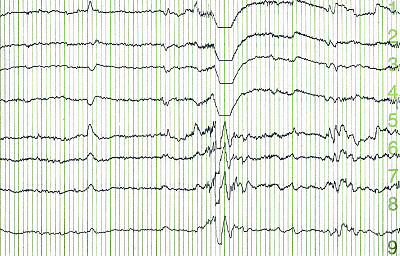 eeg
