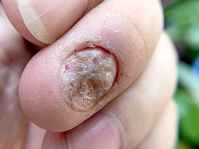 fungus