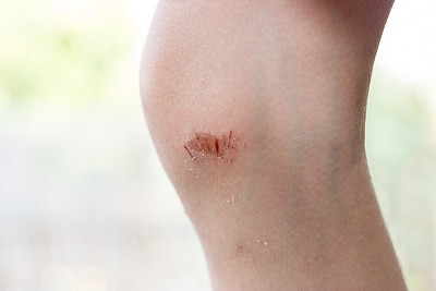 cuts