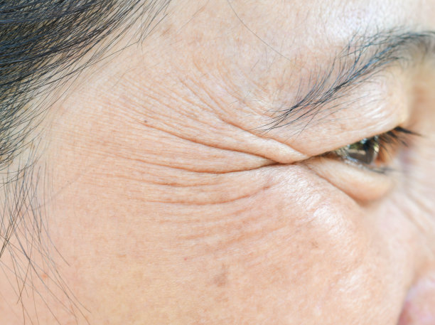 wrinkles
