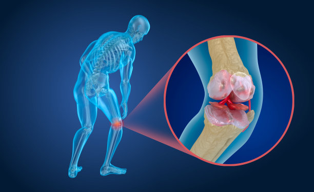 arthritis