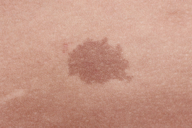 mole