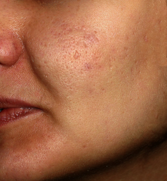 pores