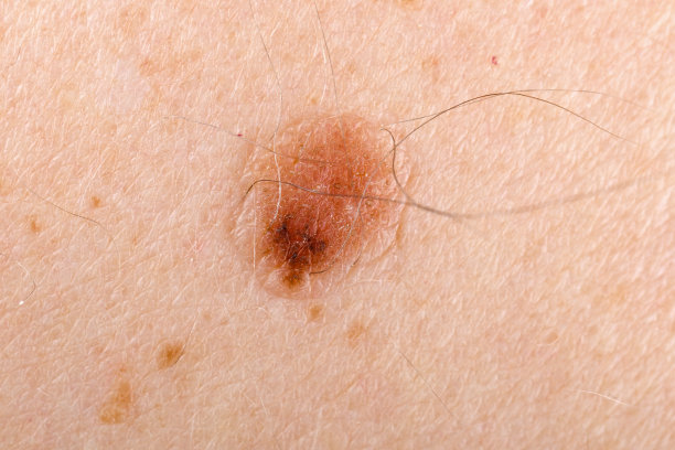 mole