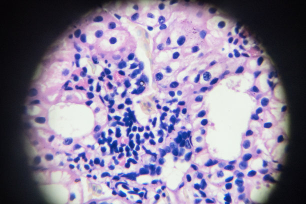 鳞状细胞癌