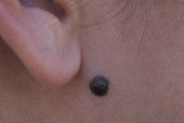 mole