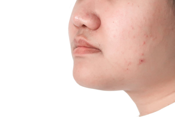 pores