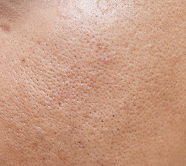 pores