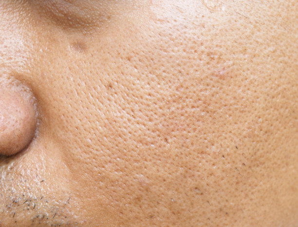 pores
