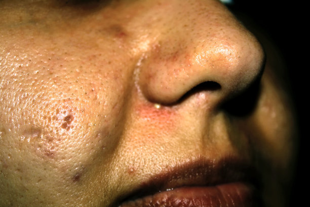 pores