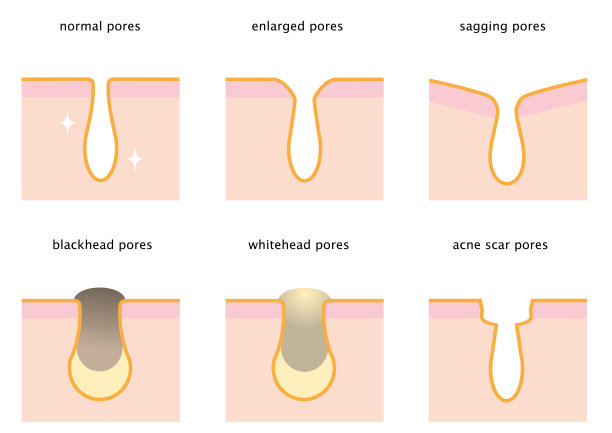 pores