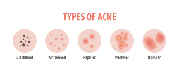 pores