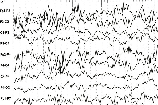 eeg