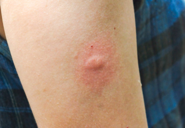 mosquito